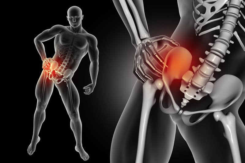 Protesis de cadera por abordaje anterior en Mérida, Yucatán